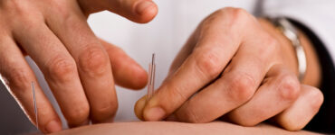 - Veja como adotar a acupuntura para emagrecer