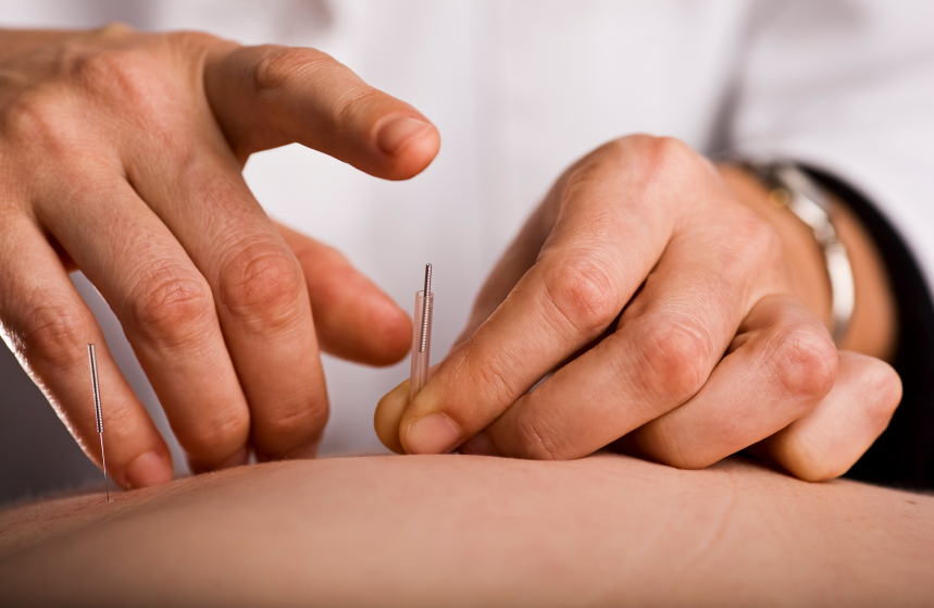 Veja como adotar a acupuntura para emagrecer 2 - acupuntura para emagrecer Veja como adotar a acupuntura para emagrecer